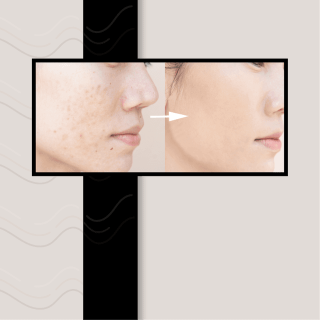 8 Week Acne Bootcamp at Skin By Becca in Holly Springs, NC